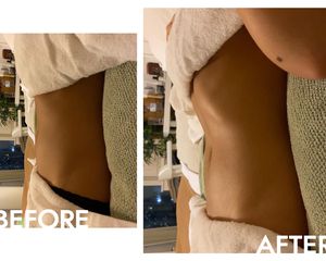 Before and after Brazilian lymphatic drainage massage