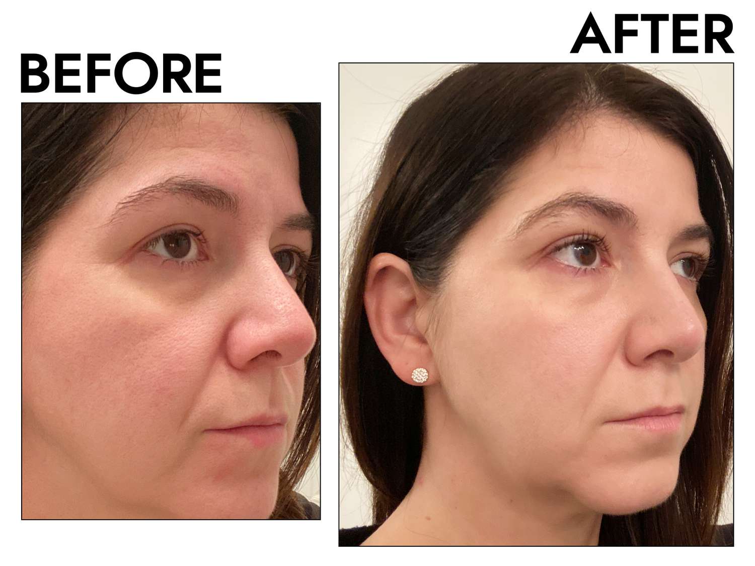 a tester before and after using Macrene Actives High Performance Face Serum