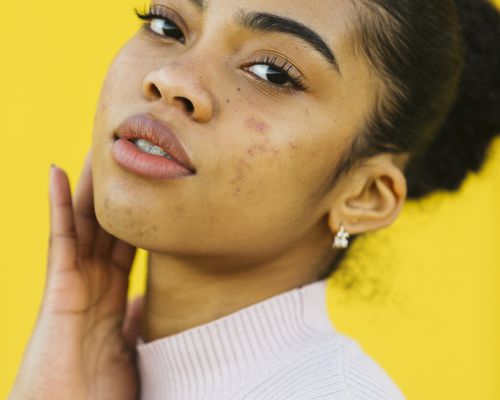 Young girl with acne 