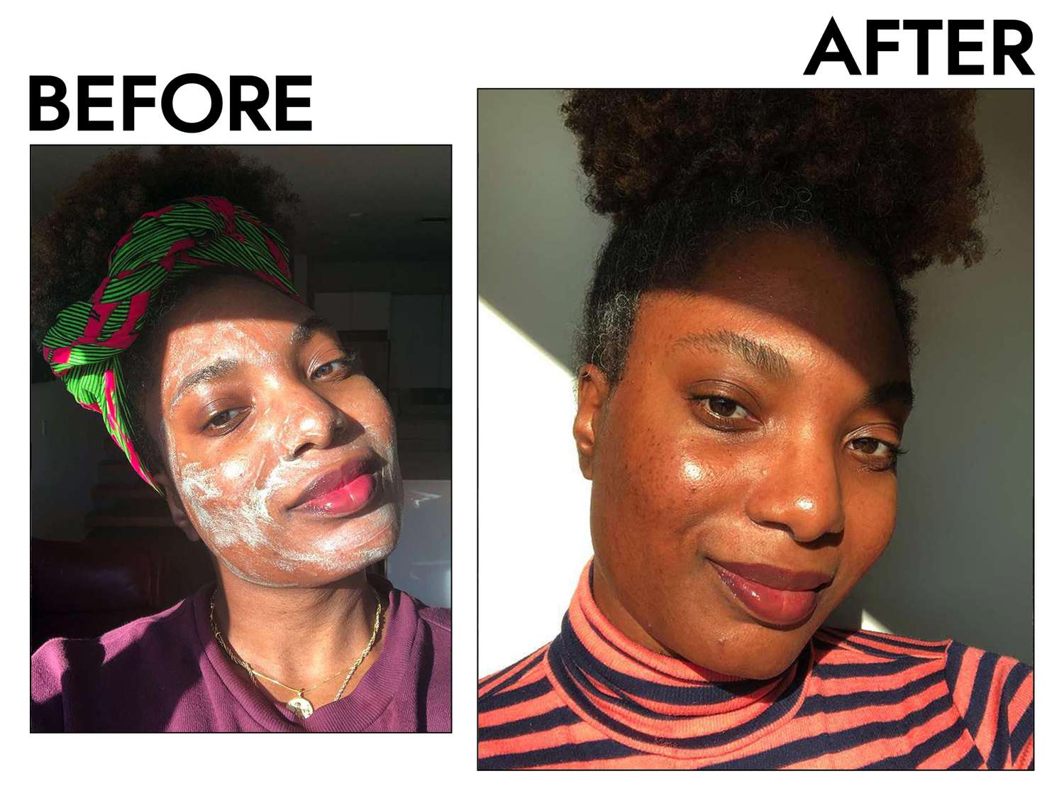 Person's face before and after using Kate Somerville ExfoliKate Intensive Exfoliating Treatment