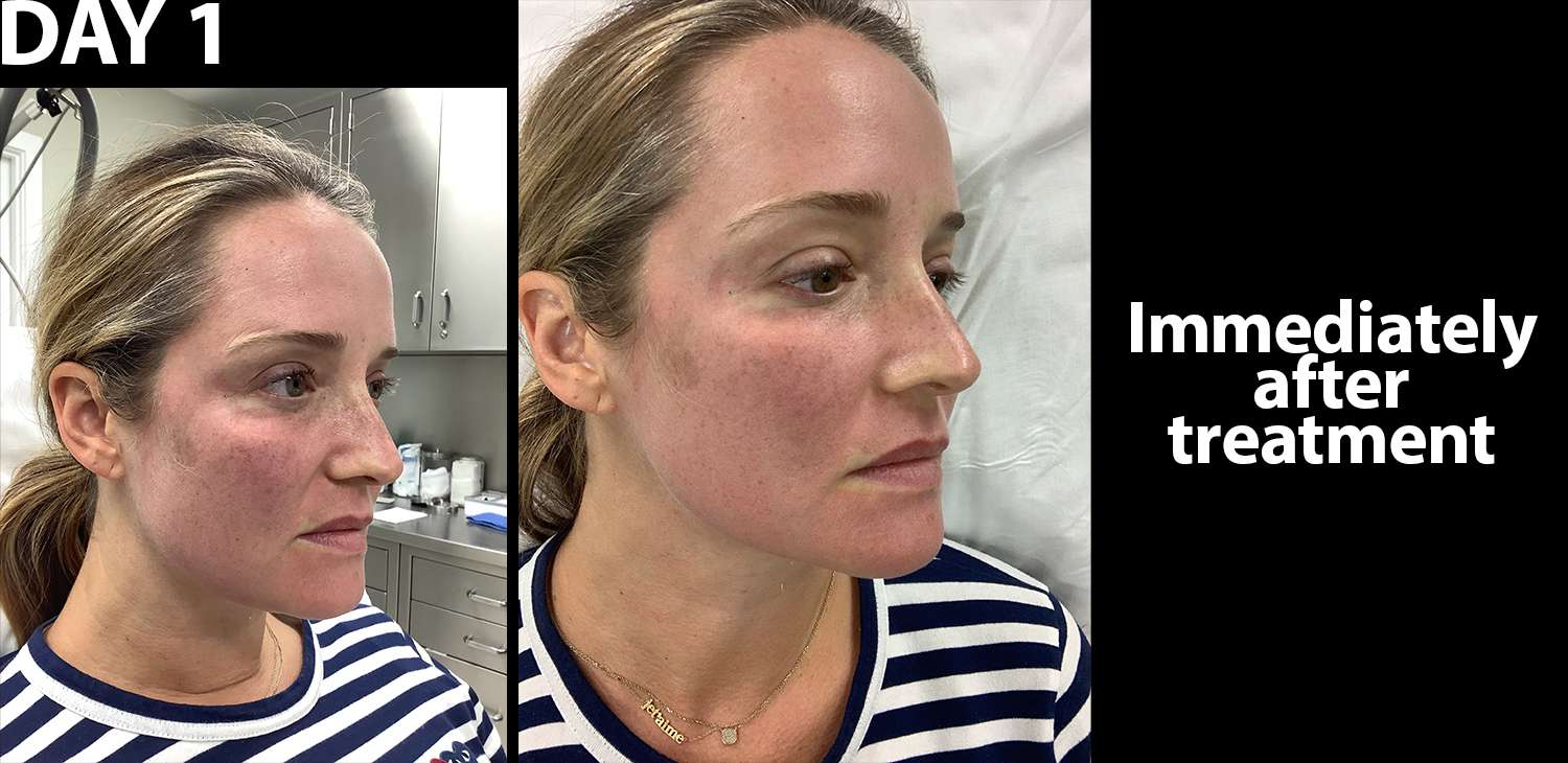 Writer's face with moderate redness immediately after Fraxel laser treatment