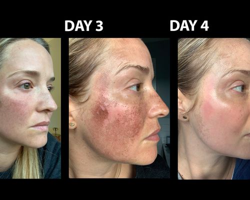 Writer Leah Wyar's day-by-day results after Fraxel laser treatment