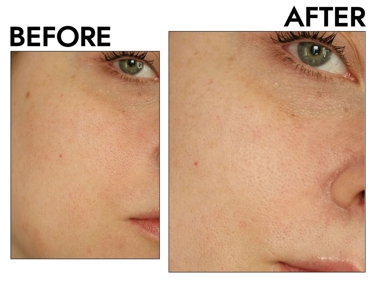 Person's face before and after using Paula's Choice Resist Daily Pore-Refining Treatment with 2 Percent BHA