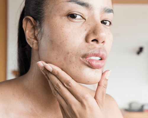 Woman with acne looking at herself while holding her chin in her hand.