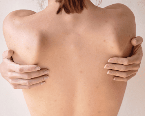 A woman's back with breakouts and her hands grasping each side