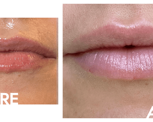 lip filler before and after photo close up