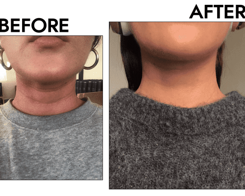 woman's neck filler before and after photo