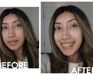 Byrdie writer Karla Ayala's skin before and after applying the OLAY Super Serum 5-in-1 face serum