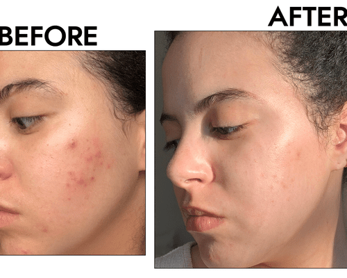 woman with acne before and after photo