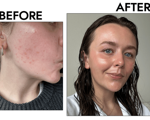 before and after photo of tretinoin for acne